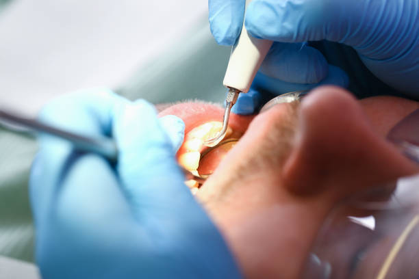 Best Emergency Wisdom Tooth Extraction in Biloxi, MS