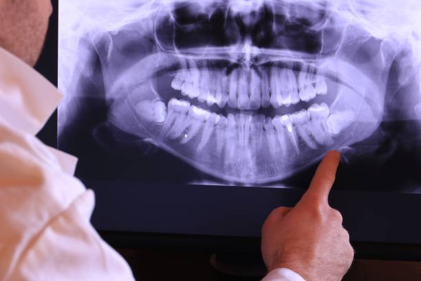 Best Knocked-Out Tooth (Avulsed Tooth) Treatment in Biloxi, MS